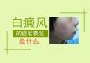 專(zhuān)科醫(yī)院講解泛發(fā)型白癜風(fēng)的癥狀表現(xiàn)有哪些?