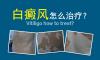 白癜風(fēng)應(yīng)該怎樣治療?治療白癜風(fēng)病醫(yī)院